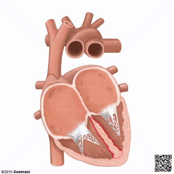 Septo Interventricular